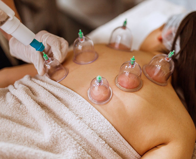 Cupping Therapy image 1