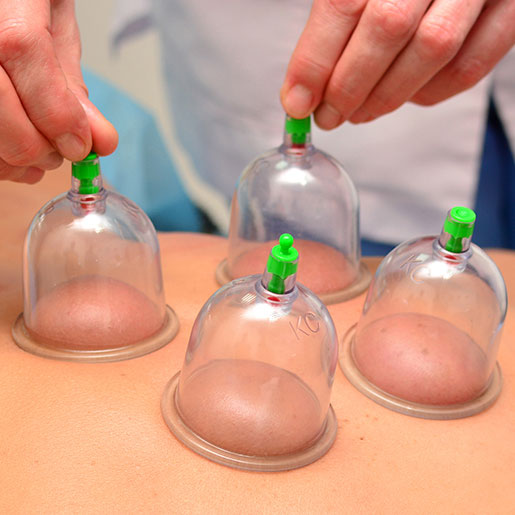 Cupping Therapy image 2